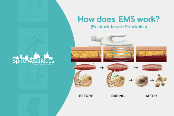 EMS treatment for post pregnancy weight loss treatment Melksham
