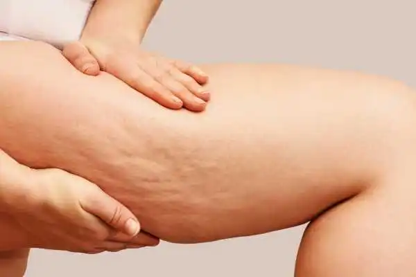 Image of woman showing leg with cellulite Melksham