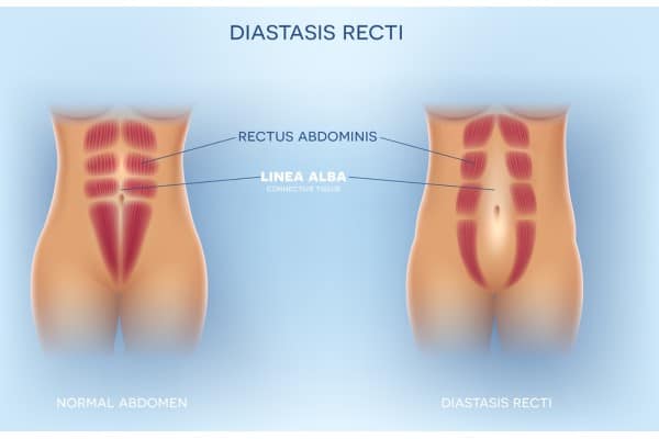 What Non-Surgical Options Are Available for Diastasis Recti Melksham?
