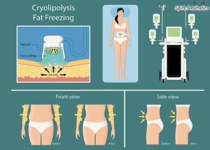 Fat freezing treatment Melksham benefits for competitions to remove stubborn fat deposits.