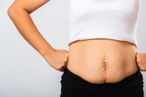 Image of a woman's stomach after weight loss with sagging skin following a gastric band Melksham