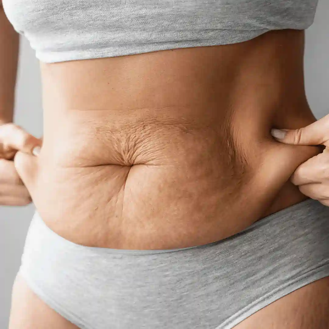 Is It Normal to Have Loose Skin After Pregnancy Melksham?