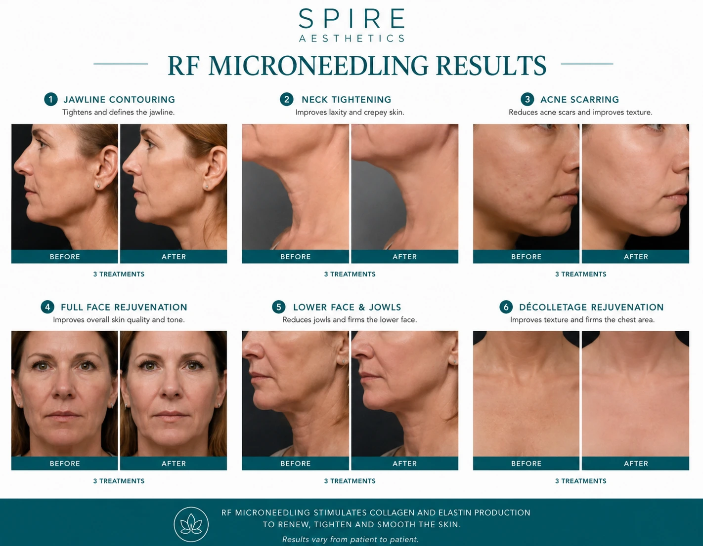 RF Microneedling Skin tightening Melksham results