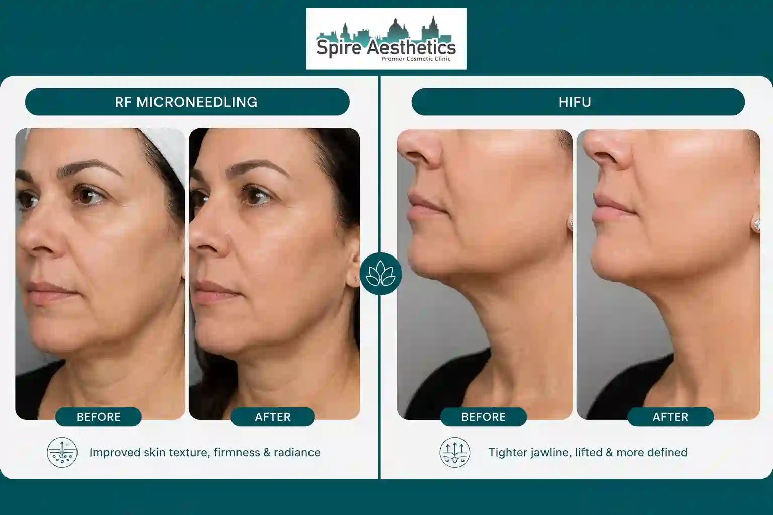 Can RF Microneedling and HIFU Be Combined Melksham?